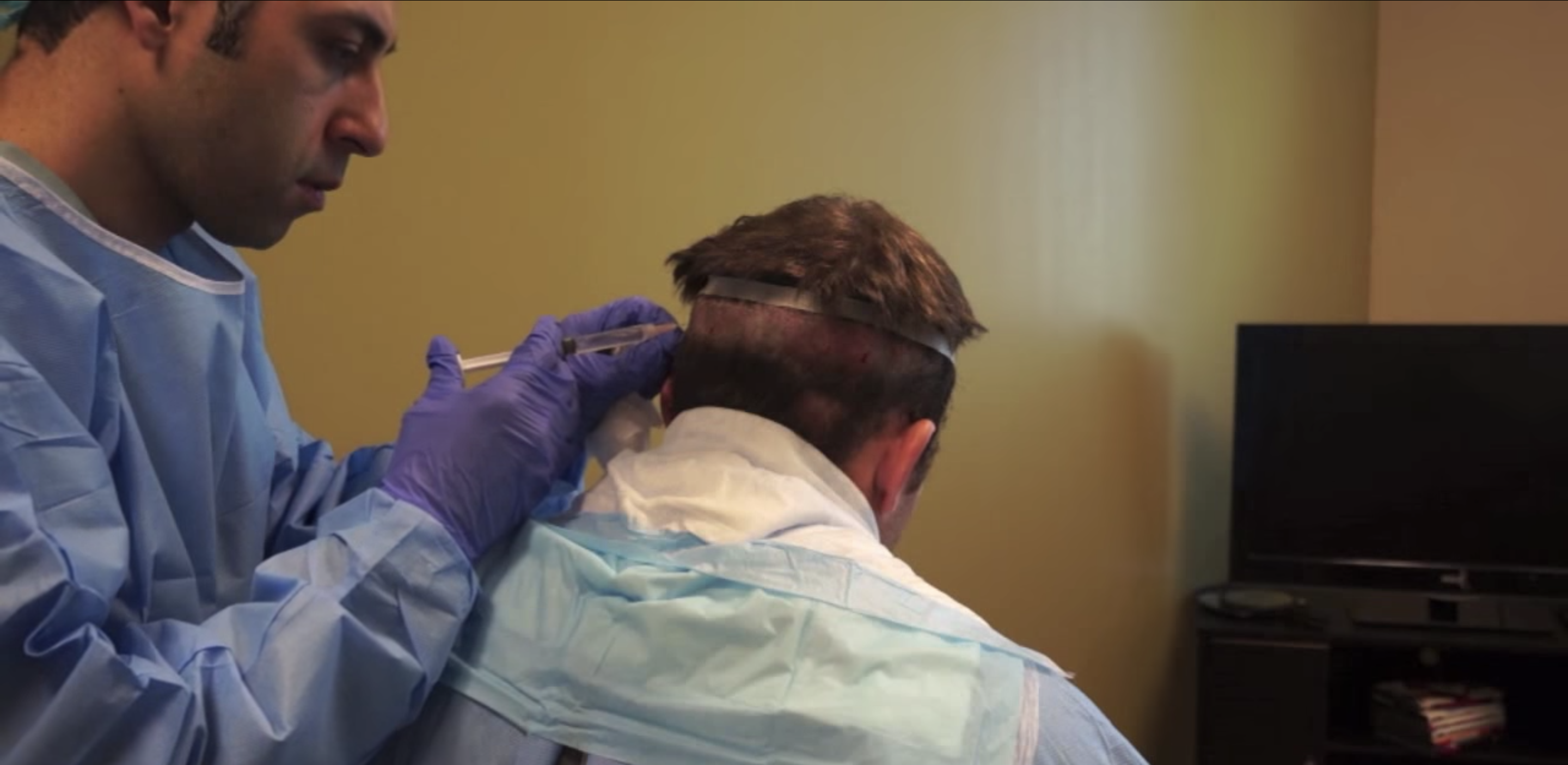 Why FUT Procedures are Still Valid in the Era of FUE Modena Hair