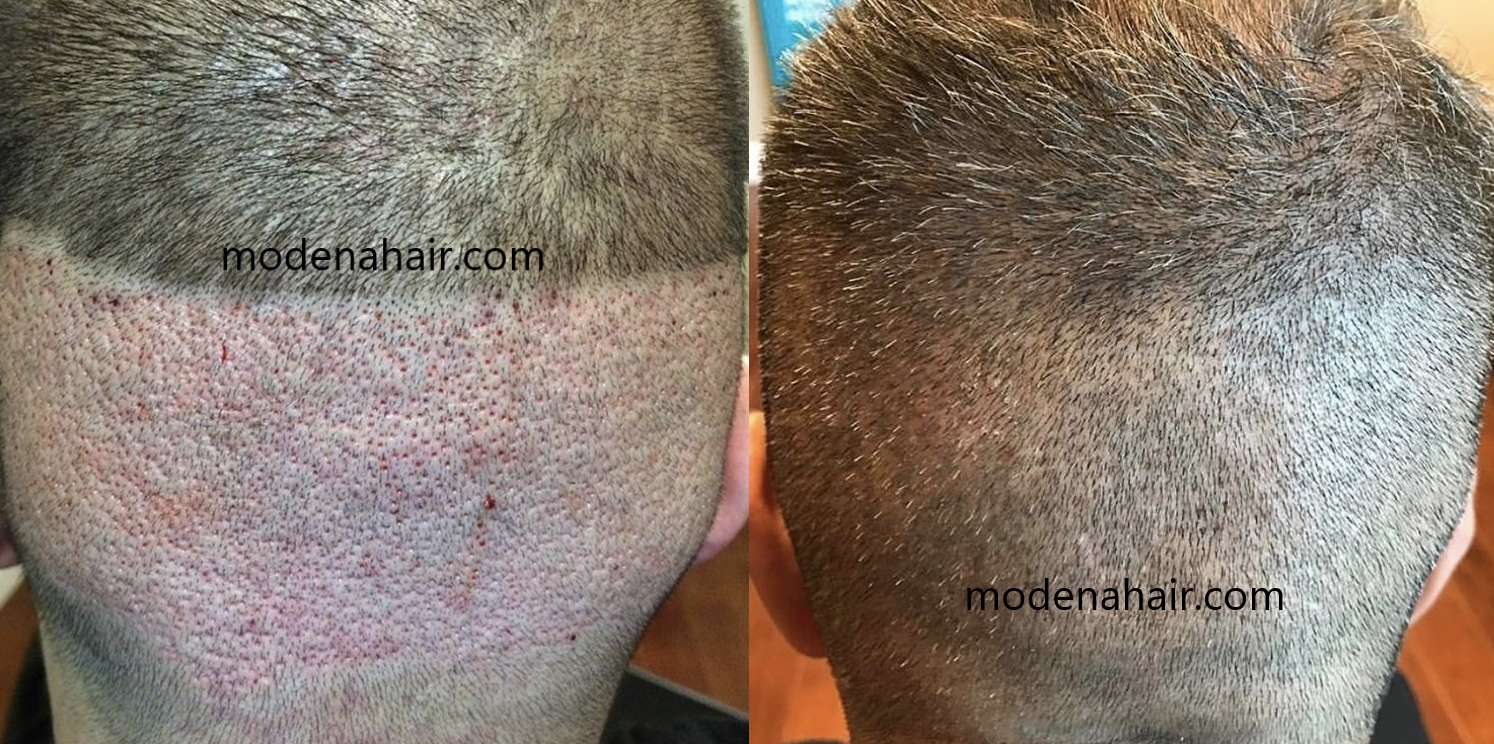 hair transplant scar healing time