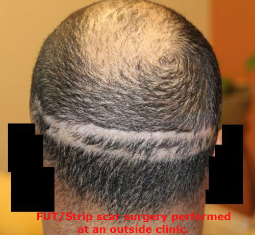 How long is a recovery from sapphire hair transplant surgery for men? -  Cyber Hairsure