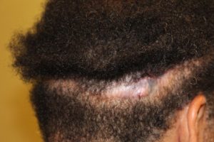botched strip fut scar