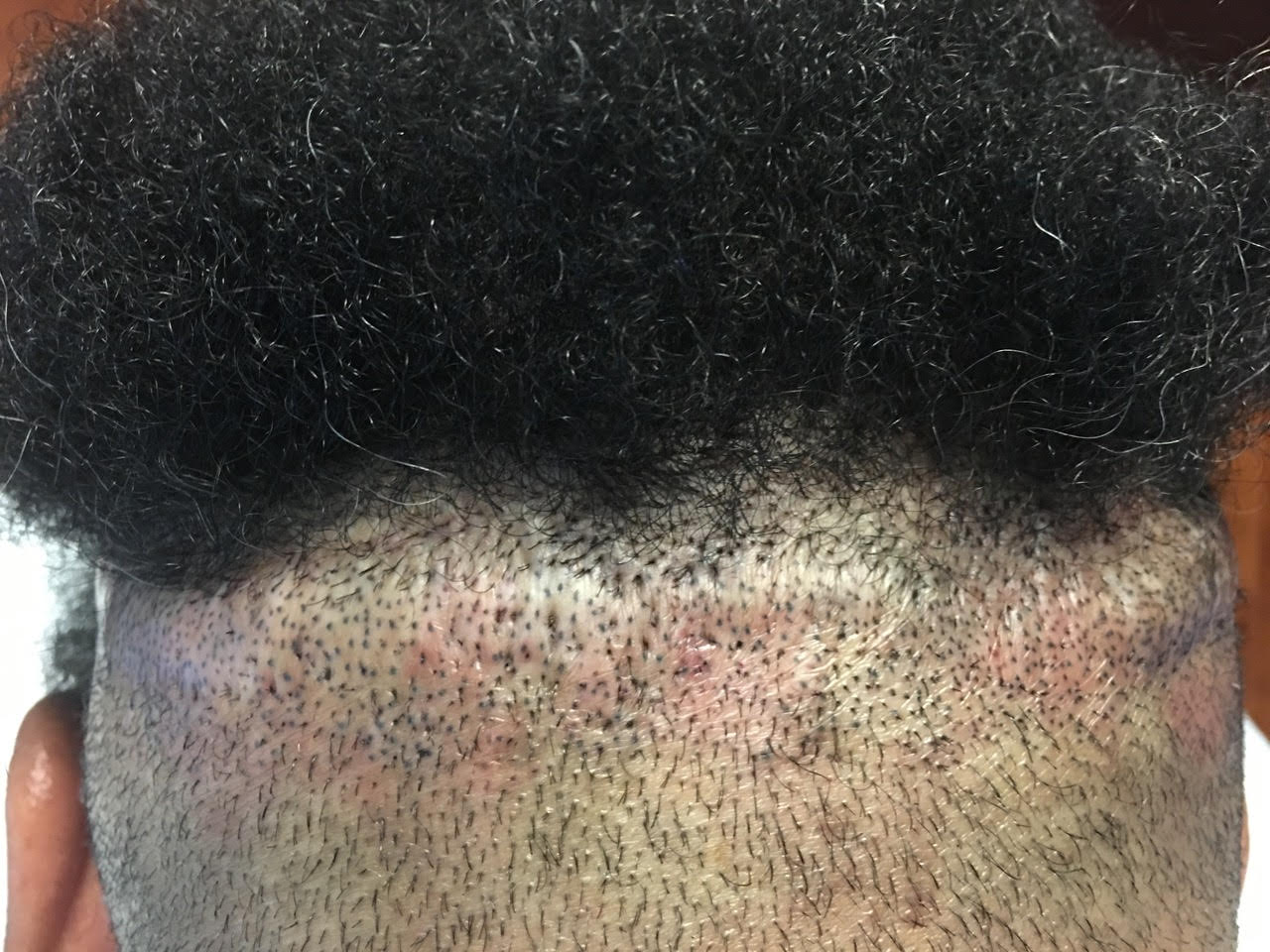 Case Study - Botched Strip FUT Scar Repaired by Dr. Yazdan Using Scalp ...