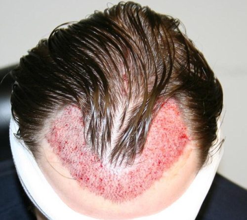 direction in hair transplant