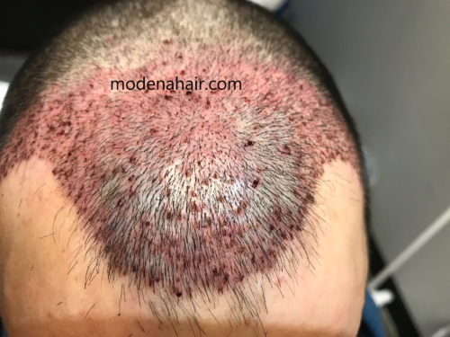 finasteride before and after hairline