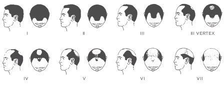 male hair loss chart