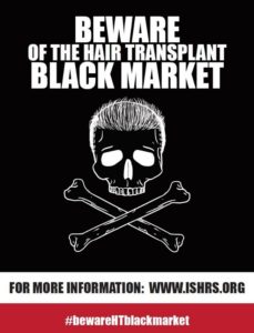 beware hair transplant black market